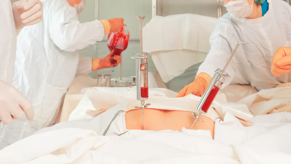 Understanding the Bone Marrow Transplant Procedure (for thalassemia patients)